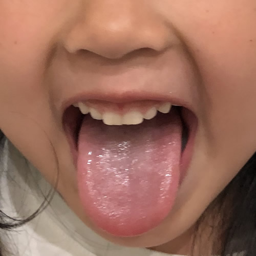 のど・口・舌の病気